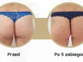 Widoczne **efekty endermologii po 6 zabiegach** na pośladkach. Skóra jest gładsza, bardziej jędrna i napięta.