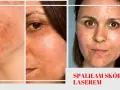 Jak długo goi się skóra po laserze frakcyjnym? Czas regeneracji