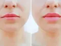 Przed i po zabiegu: usta po lip flip. Zobacz opinie i efekty.