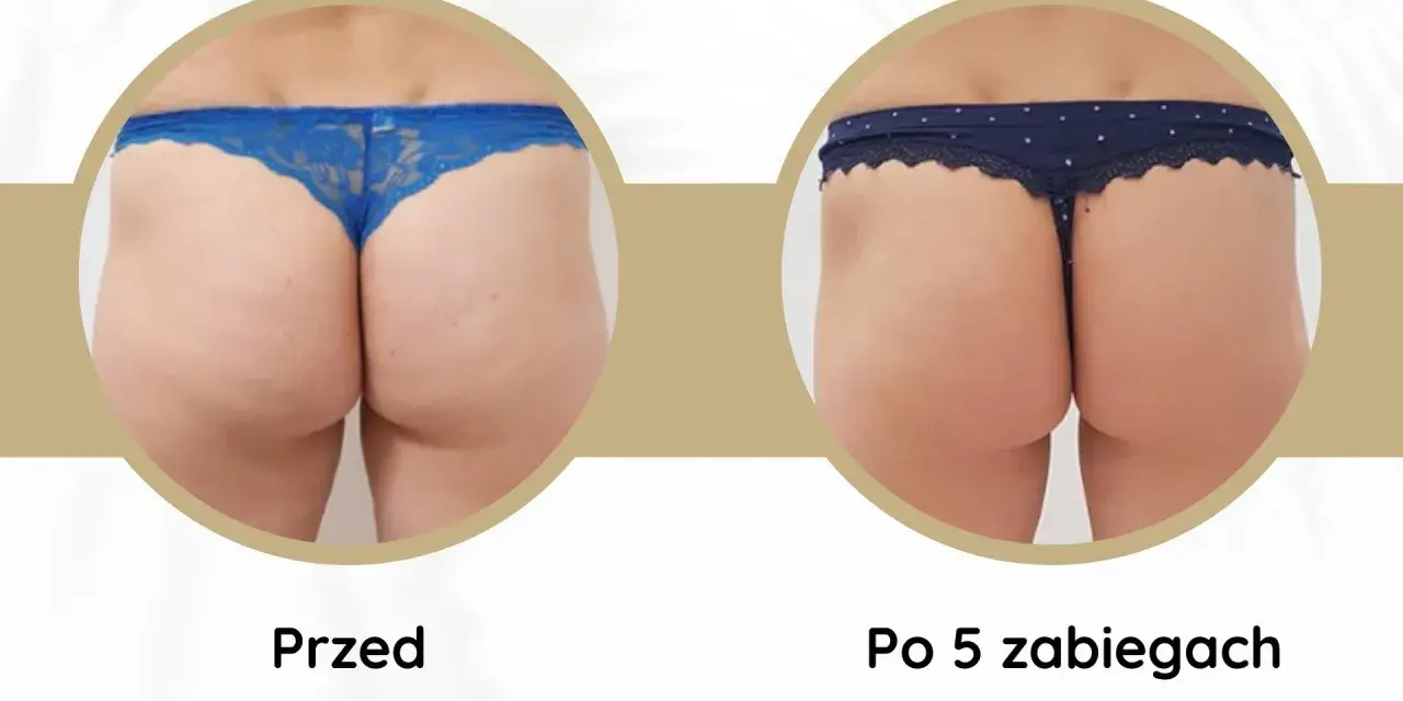 Widoczne **efekty endermologii po 6 zabiegach** na pośladkach. Skóra jest gładsza, bardziej jędrna i napięta.