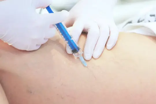 Lekarz w białej rękawiczce wykonuje zastrzyk strzykawką w nogę z widocznymi naczynkami. To skleroterapia żylaków opinie.