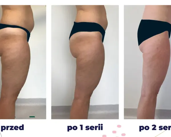 Efekty zabiegu iCoone na uda: przed, po 1 i po 2 seriach. Widoczna redukcja cellulitu i poprawa jędrności skóry.
