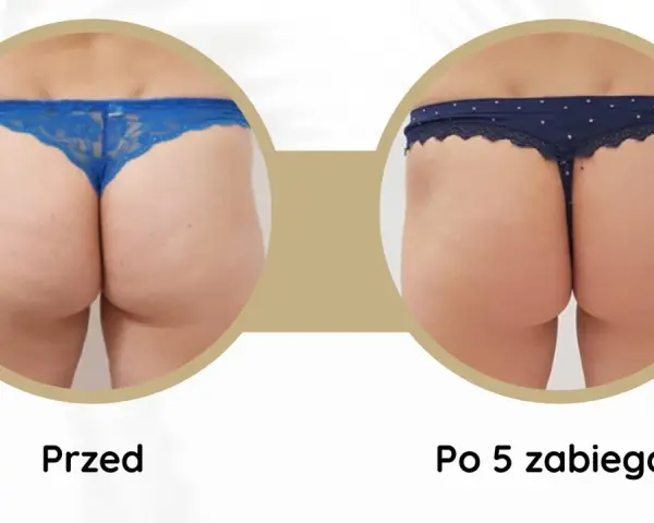Widoczne **efekty endermologii po 6 zabiegach** na pośladkach. Skóra jest gładsza, bardziej jędrna i napięta.