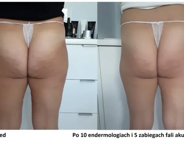 Widoczne efekty endermologii po 10 zabiegach i 5 fal akustycznych na uda. Skóra na pośladkach i udach jest gładsza, cellulit zredukowany.