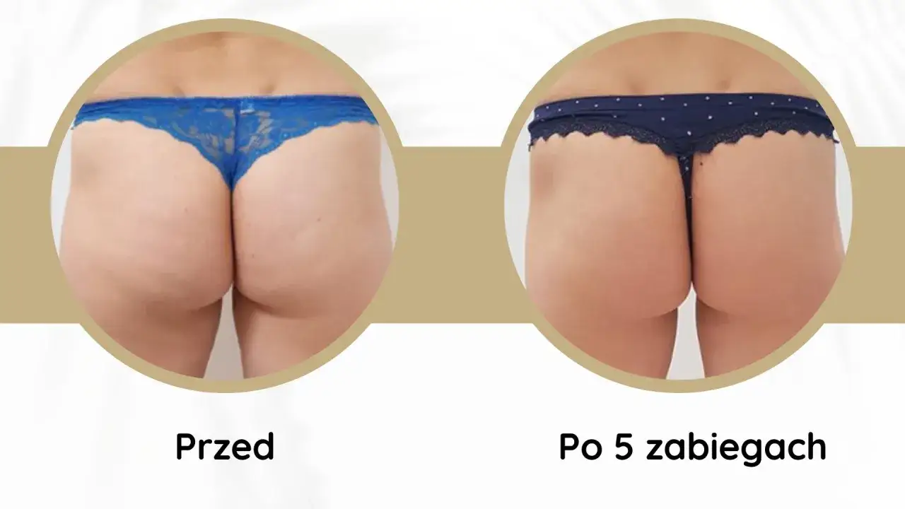 Widoczne efekty endermologii po 5 zabiegach: wygładzona skóra, redukcja cellulitu i poprawa kształtu pośladków.