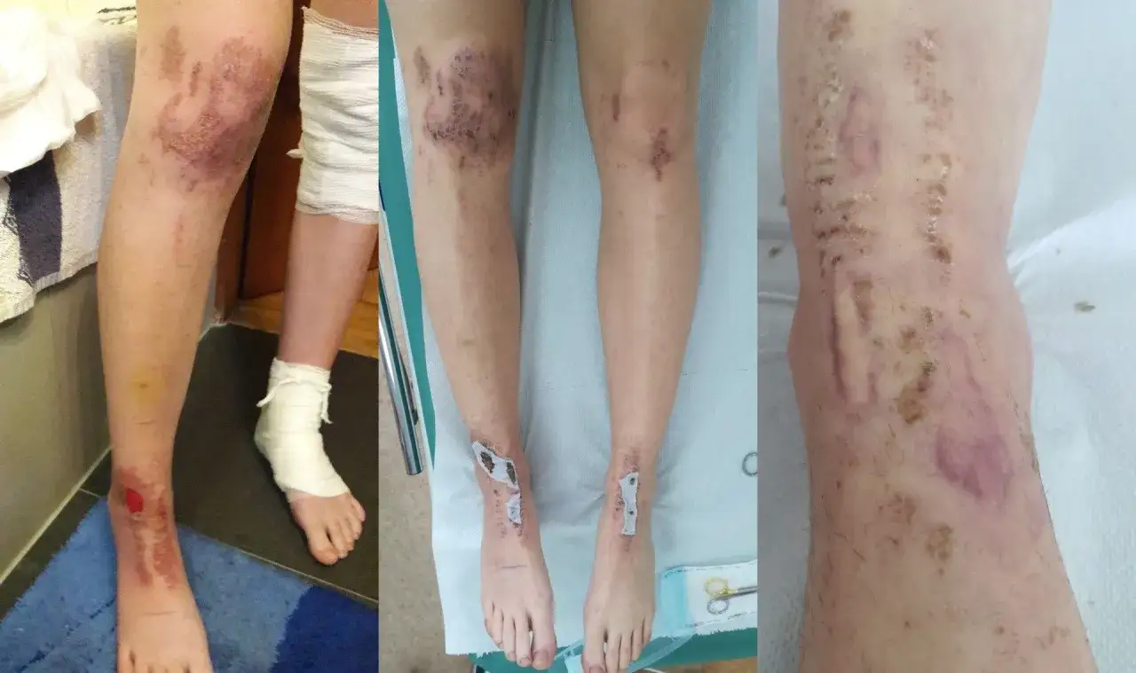 Oparzenia po depilacji laserowej opinie: zdjęcia pokazują poważne uszkodzenia skóry na nogach, w tym zaczerwienienia, pęcherze i strupy.