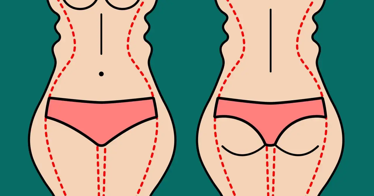 Przed i po zabiegu liposukcji ultradźwiękowej. Opinie pacjentów potwierdzają skuteczność w modelowaniu sylwetki.
