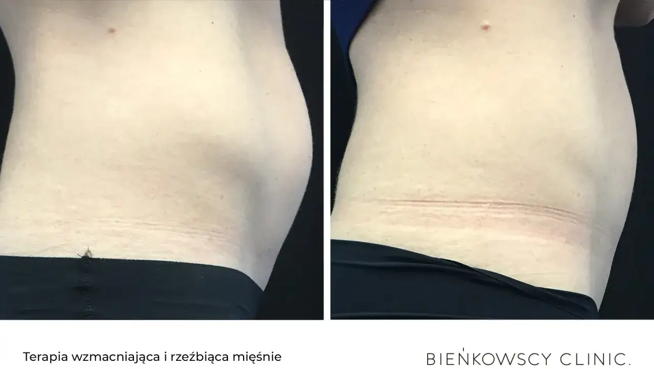 Przed i po: elektrostymulacja efekty po 10 zabiegach. Widoczna poprawa napięcia skóry i zarysowania mięśni brzucha.